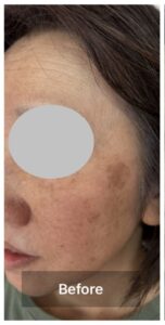 半年間でシミがここまで…！驚きの変化と、美肌への最短ルート💗